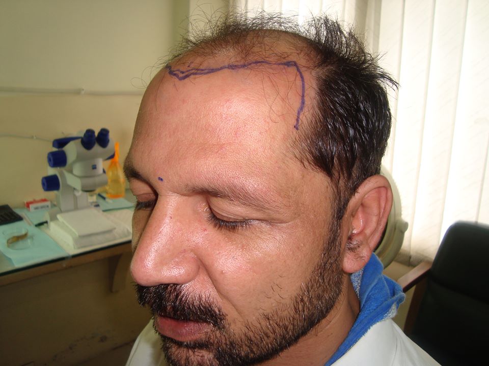 Side Effects of Hair Transplant Surgery and their Best Curing Practices -  ILHT